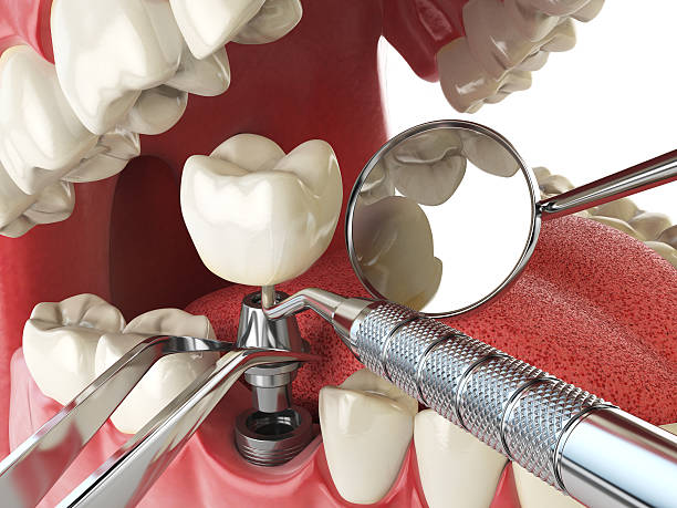 Best Emergency Root Canal Treatment in Big Beaver, PA